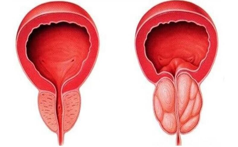 vesela un iekaisusi prostata ar prostatītu