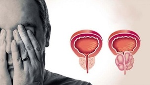 vīriešu prostatīta cēloņi