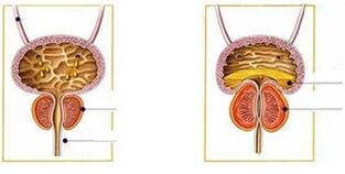 vīriešu prostatīta veidi un formas