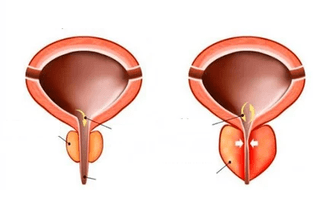 kas ir akūts prostatīts