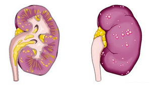 kas izraisa akūtu prostatītu