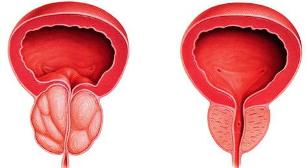 atšķirība ir slims un veselīgu prostatas